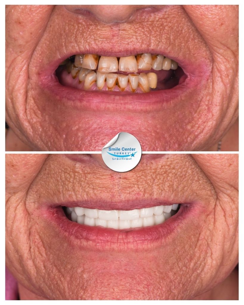 June H. – Smile Center Turkey®