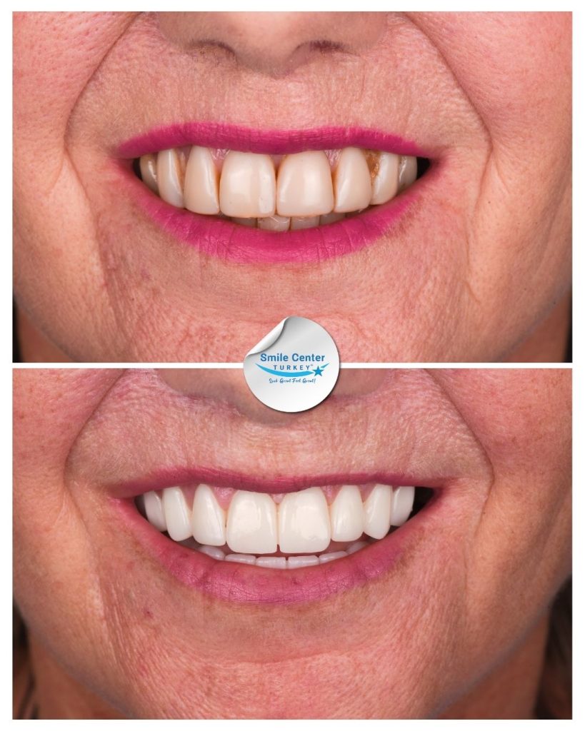 Veronica D. – Smile Center Turkey®