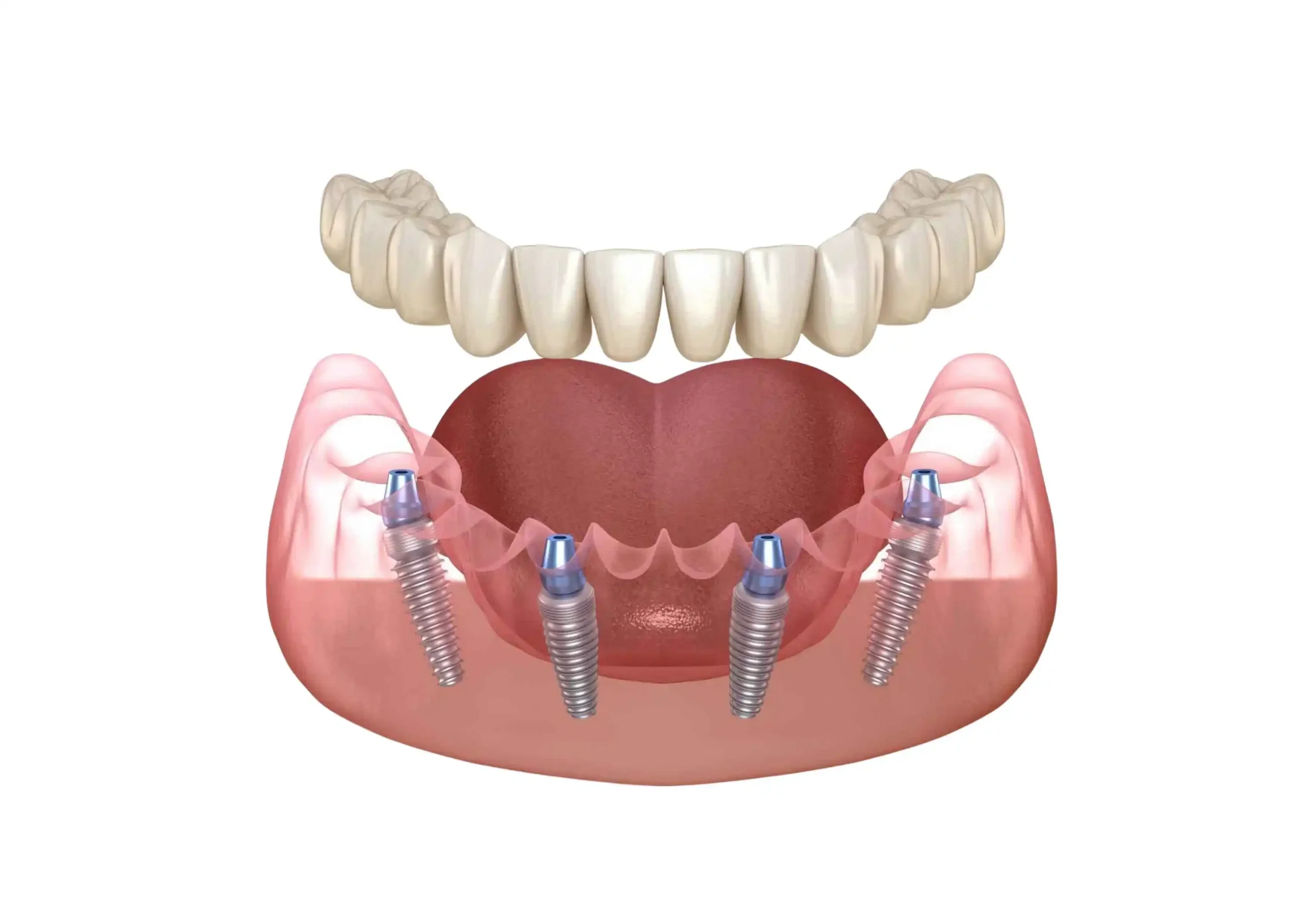 All-on-4 dental implants illustration