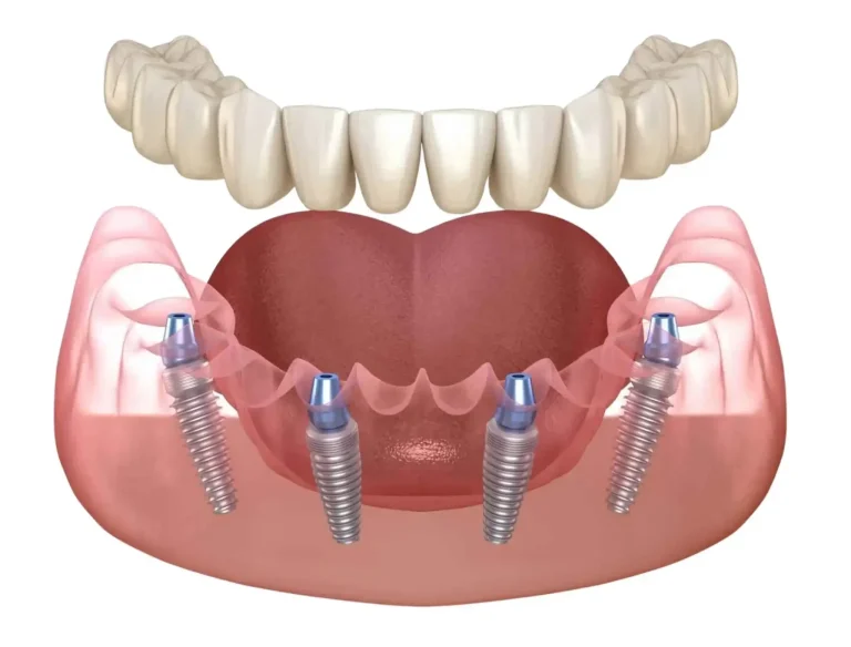 All-on-4 dental implants in Antalya, Turkey at Smile Center Turkey dental clinic (full mouth implants)