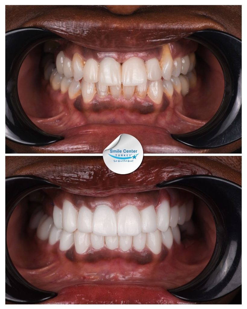 Jacqueline S. – Smile Center Turkey®