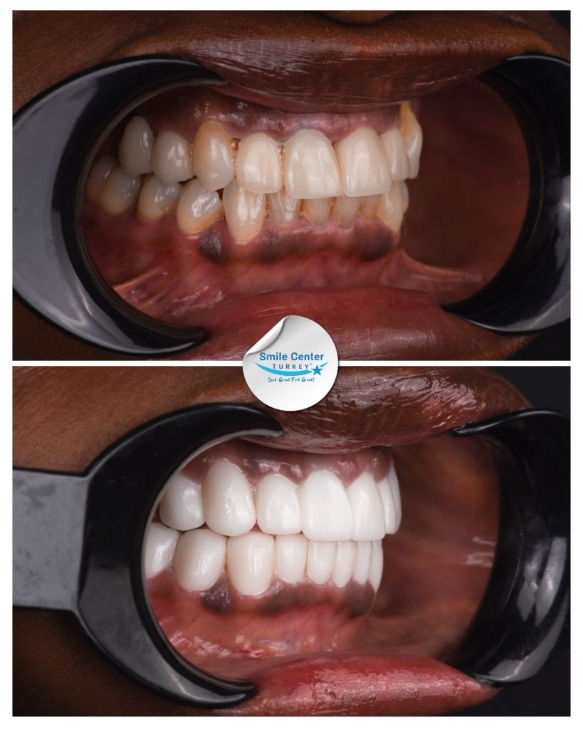 Jacqueline S. – Smile Center Turkey®