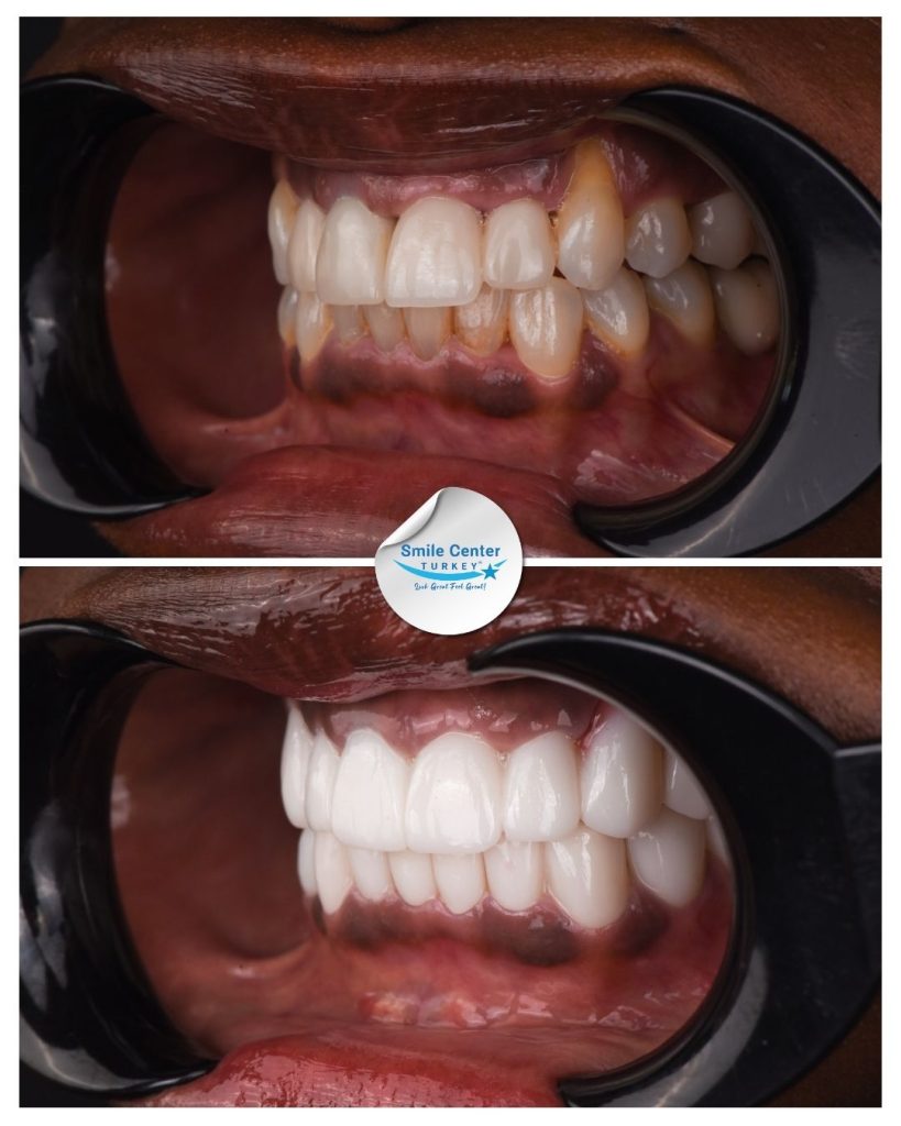 Jacqueline S. – Smile Center Turkey®