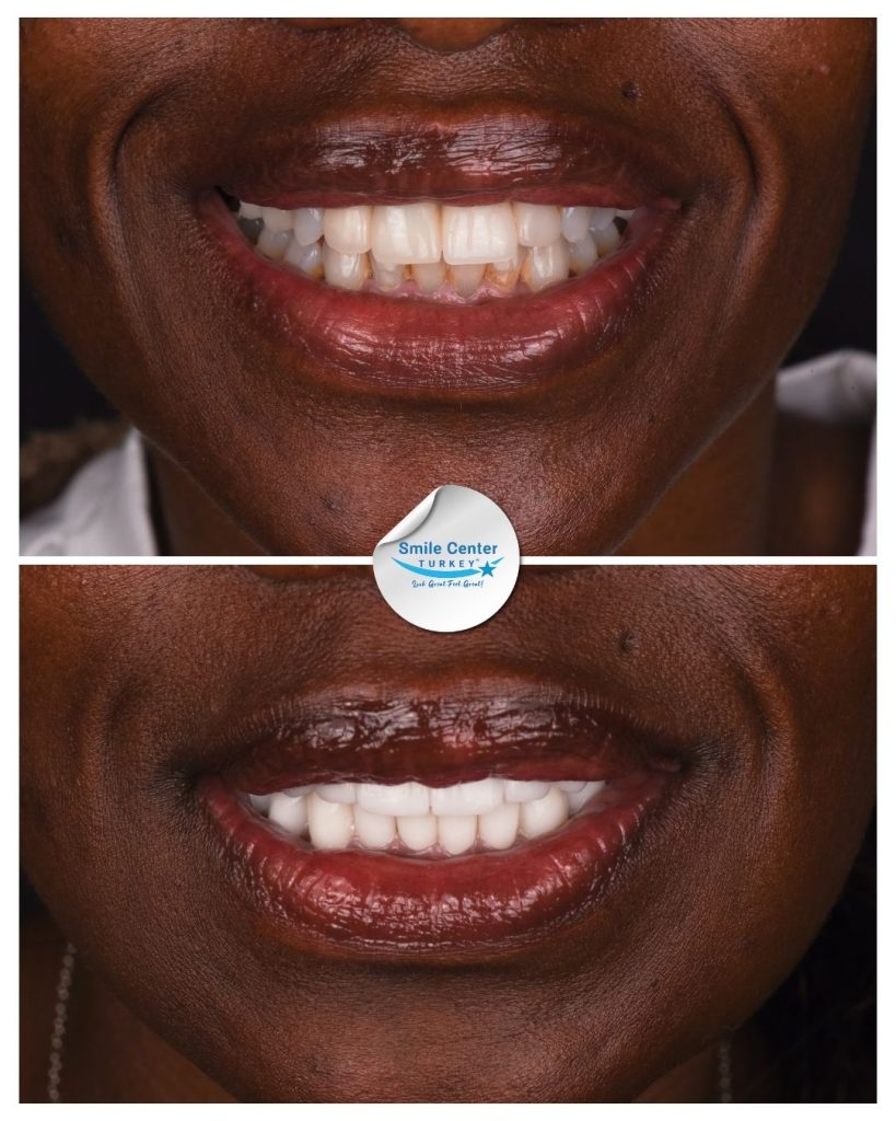 Jacqueline S. – Smile Center Turkey®